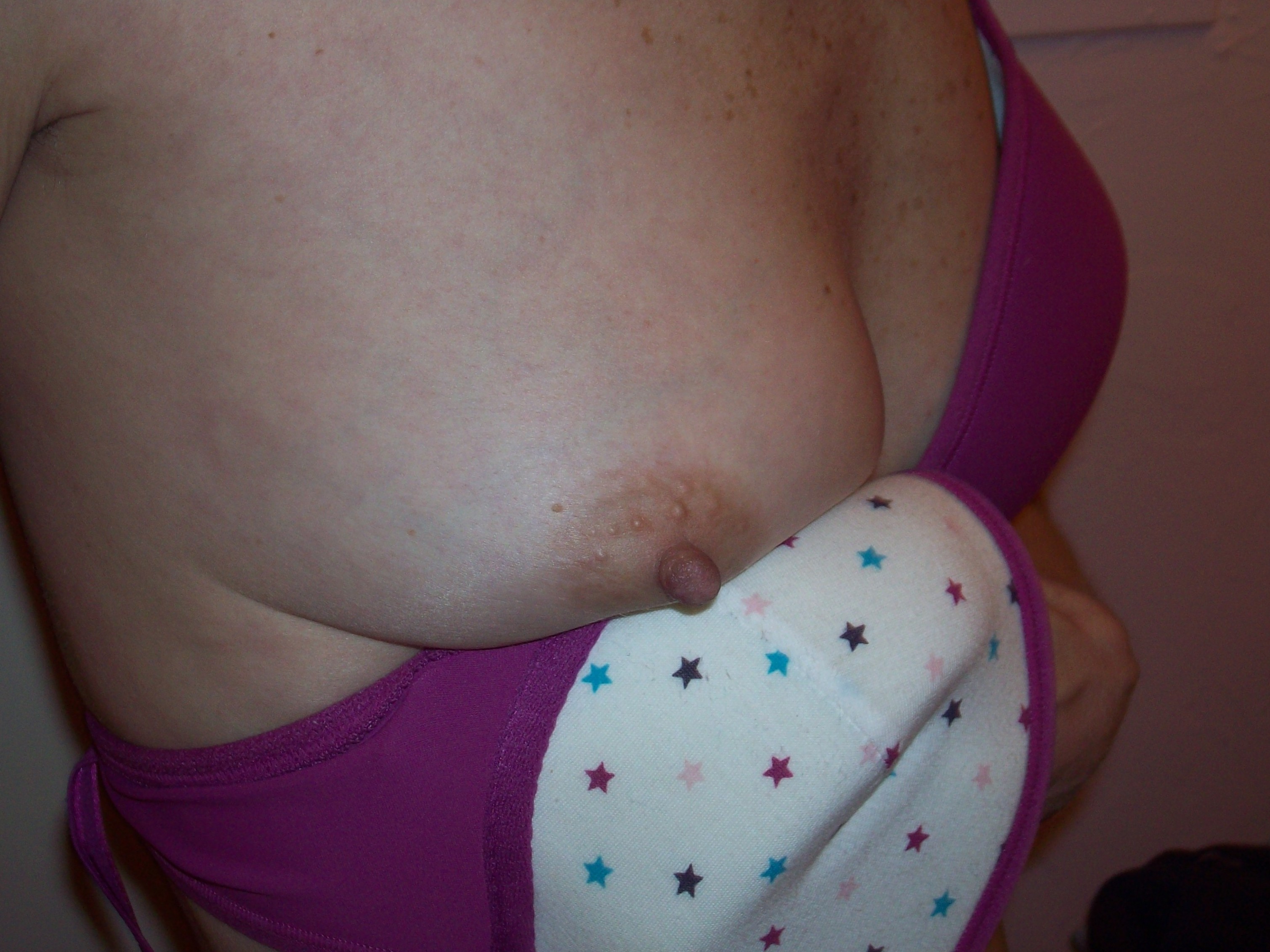 Breast and nipple